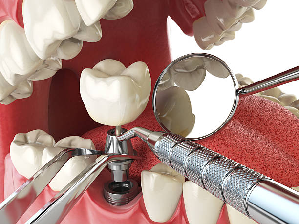 Best Broken or Chipped Tooth Repair in Electra, TX